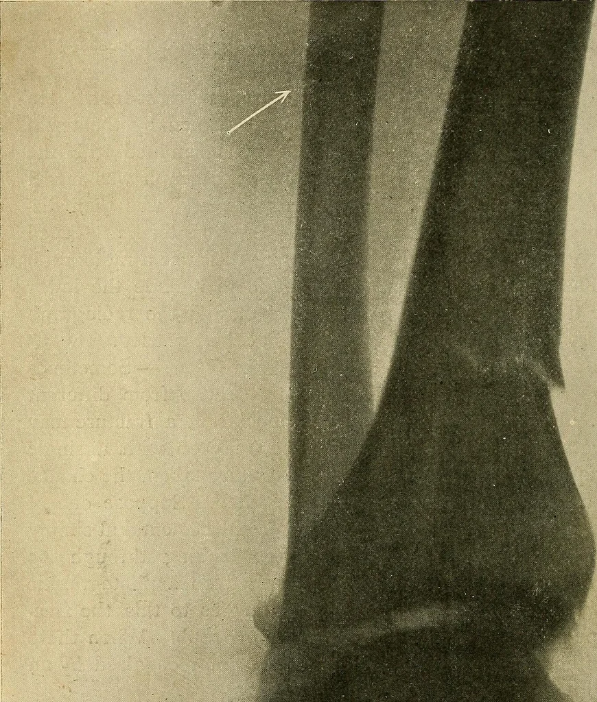 An illustration from The Roentgen rays in medicine and surgery as an aid in diagnosis and as a therapeutic agent : designed for the use of practitioners and students, 1901, leaf 487