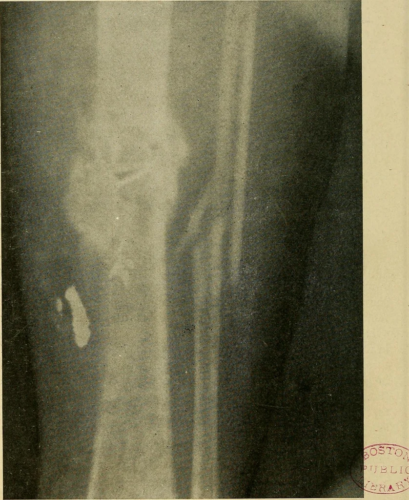An illustration from The Roentgen rays in medicine and surgery as an aid in diagnosis and as a therapeutic agent : designed for the use of practitioners and students, 1901, leaf 491