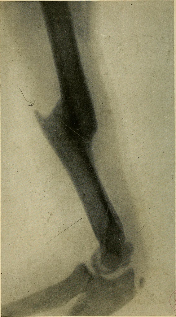 An illustration from The Roentgen rays in medicine and surgery as an aid in diagnosis and as a therapeutic agent : designed for the use of practitioners and students, 1901, leaf 495