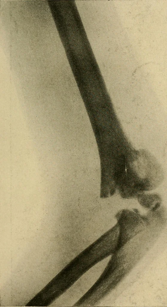 An illustration from The Roentgen rays in medicine and surgery as an aid in diagnosis and as a therapeutic agent : designed for the use of practitioners and students, 1901, leaf 496