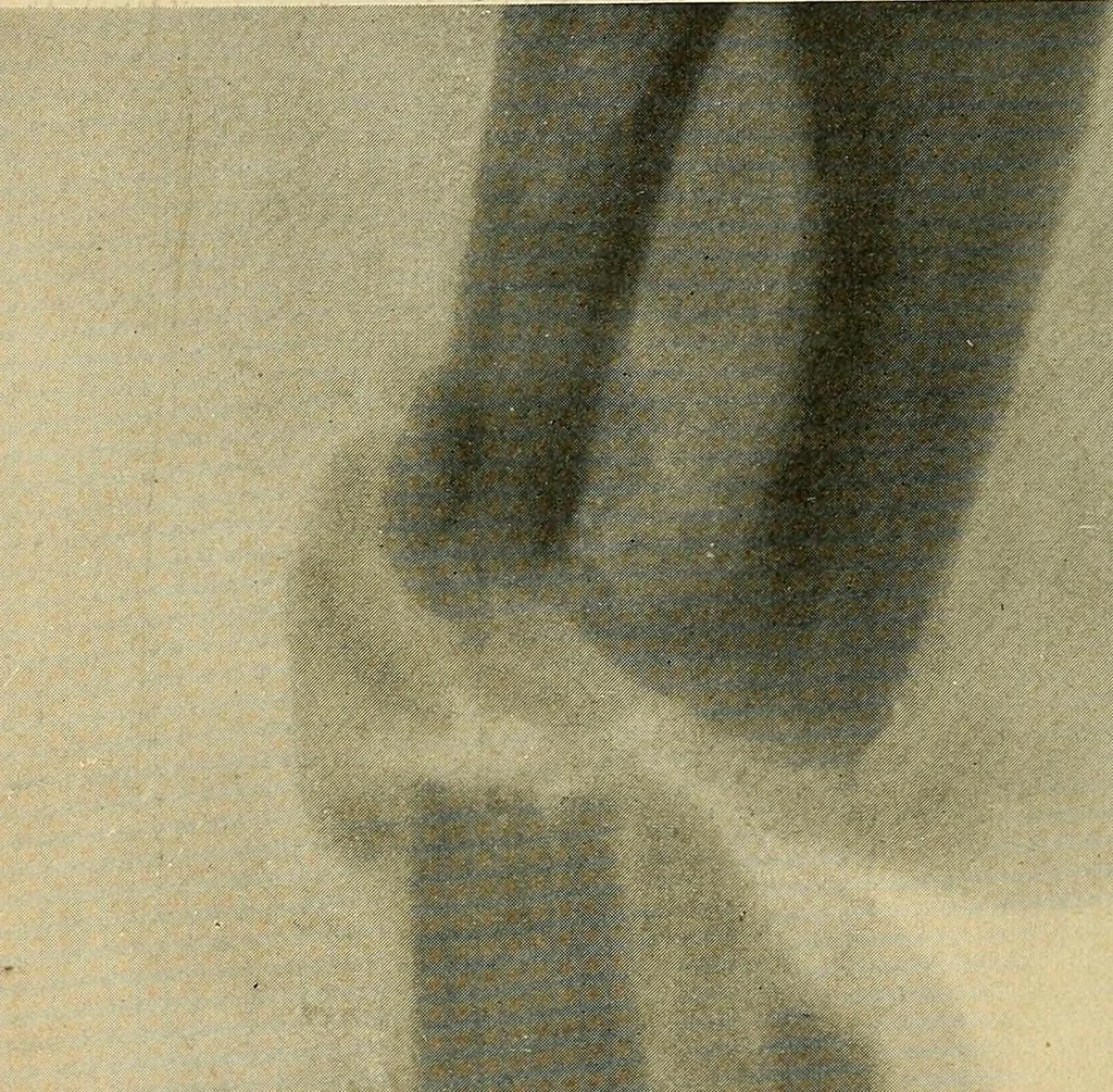 An illustration from The Roentgen rays in medicine and surgery as an aid in diagnosis and as a therapeutic agent : designed for the use of practitioners and students, 1901, leaf 499