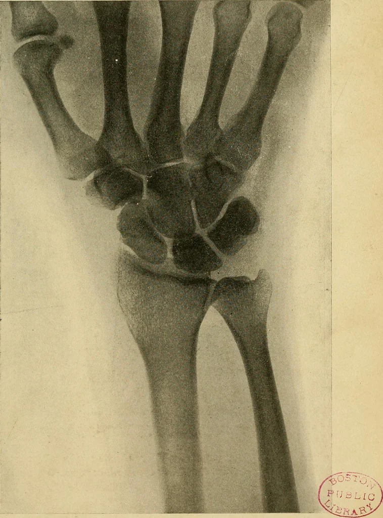 An illustration from The Roentgen rays in medicine and surgery as an aid in diagnosis and as a therapeutic agent : designed for the use of practitioners and students, 1901, leaf 500