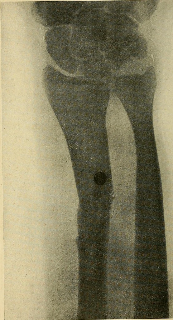 An illustration from The Roentgen rays in medicine and surgery as an aid in diagnosis and as a therapeutic agent : designed for the use of practitioners and students, 1901, leaf 503