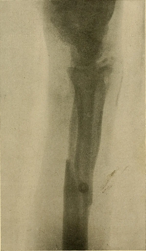 An illustration from The Roentgen rays in medicine and surgery as an aid in diagnosis and as a therapeutic agent : designed for the use of practitioners and students, 1901, leaf 504