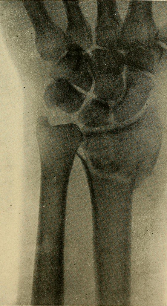 An illustration from The Roentgen rays in medicine and surgery as an aid in diagnosis and as a therapeutic agent : designed for the use of practitioners and students, 1901, leaf 506