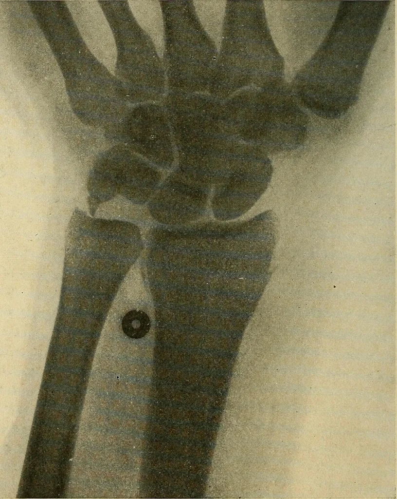 An illustration from The Roentgen rays in medicine and surgery as an aid in diagnosis and as a therapeutic agent : designed for the use of practitioners and students, 1901, leaf 507