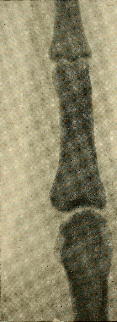 An illustration from The Roentgen rays in medicine and surgery as an aid in diagnosis and as a therapeutic agent : designed for the use of practitioners and students, 1901, leaf 510