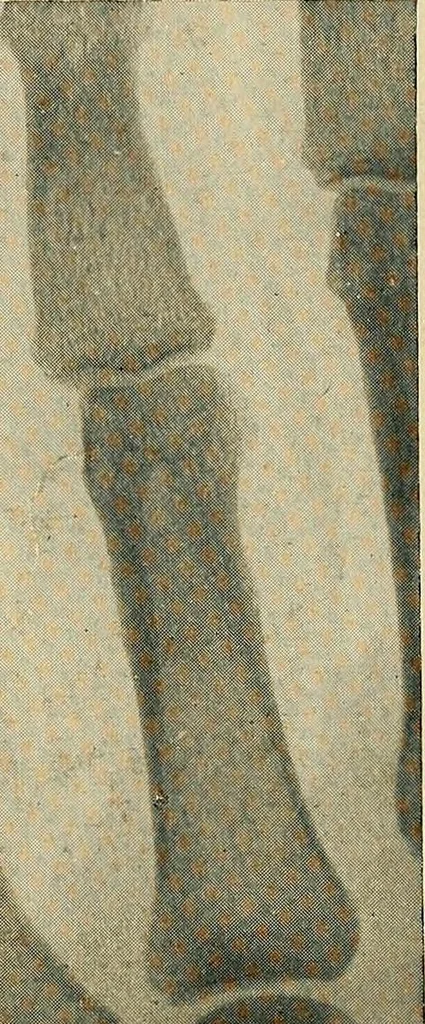 An illustration from The Roentgen rays in medicine and surgery as an aid in diagnosis and as a therapeutic agent : designed for the use of practitioners and students, 1901, leaf 512