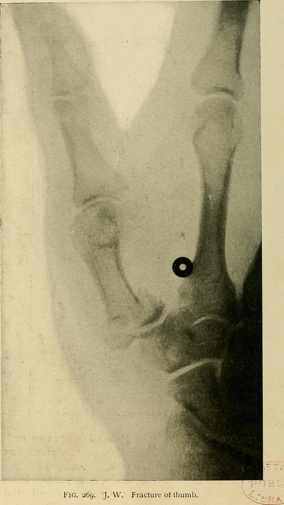 An illustration from The Roentgen rays in medicine and surgery as an aid in diagnosis and as a therapeutic agent : designed for the use of practitioners and students, 1901, leaf 513