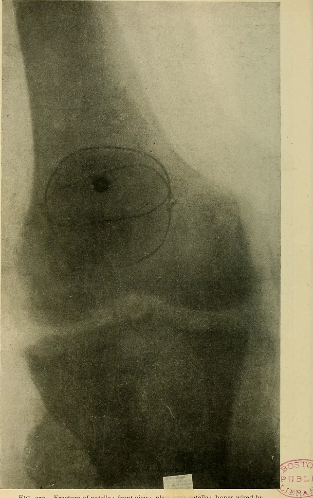 An illustration from The Roentgen rays in medicine and surgery as an aid in diagnosis and as a therapeutic agent : designed for the use of practitioners and students, 1901, leaf 517