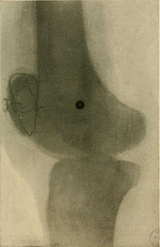 An illustration from The Roentgen rays in medicine and surgery as an aid in diagnosis and as a therapeutic agent : designed for the use of practitioners and students, 1901, leaf 518