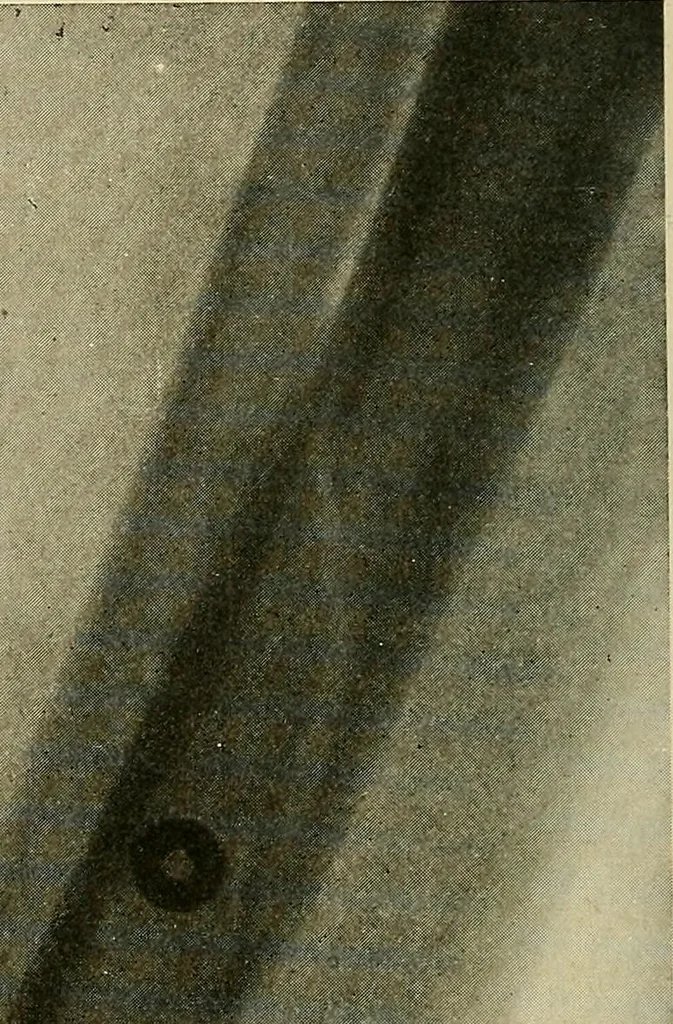 An illustration from The Roentgen rays in medicine and surgery as an aid in diagnosis and as a therapeutic agent : designed for the use of practitioners and students, 1901, leaf 519
