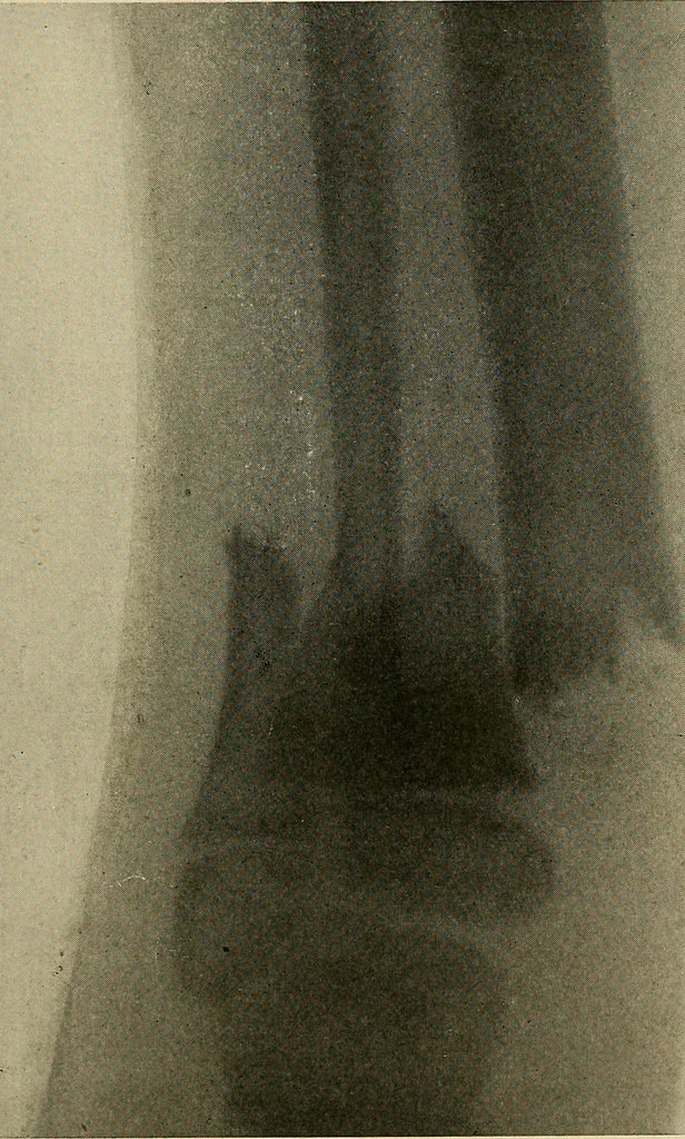 An illustration from The Roentgen rays in medicine and surgery as an aid in diagnosis and as a therapeutic agent : designed for the use of practitioners and students, 1901, leaf 522