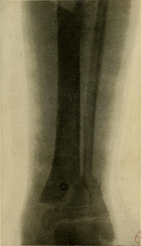 An illustration from The Roentgen rays in medicine and surgery as an aid in diagnosis and as a therapeutic agent : designed for the use of practitioners and students, 1901, leaf 524