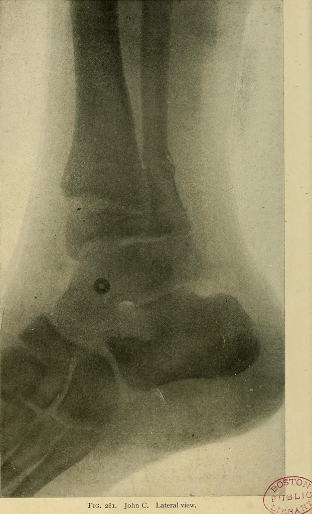 An illustration from The Roentgen rays in medicine and surgery as an aid in diagnosis and as a therapeutic agent : designed for the use of practitioners and students, 1901, leaf 525