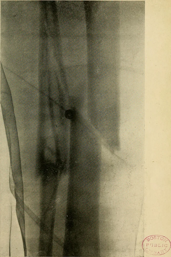 An illustration from The Roentgen rays in medicine and surgery as an aid in diagnosis and as a therapeutic agent : designed for the use of practitioners and students, 1901, leaf 526