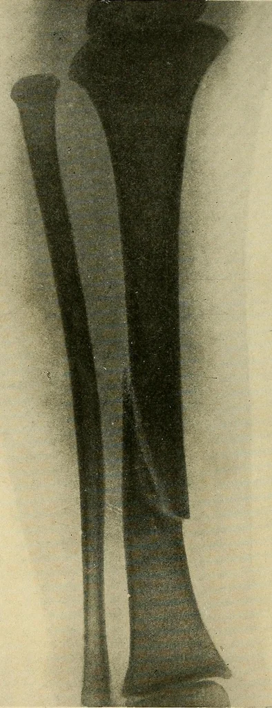 An illustration from The Roentgen rays in medicine and surgery as an aid in diagnosis and as a therapeutic agent : designed for the use of practitioners and students, 1901, leaf 529