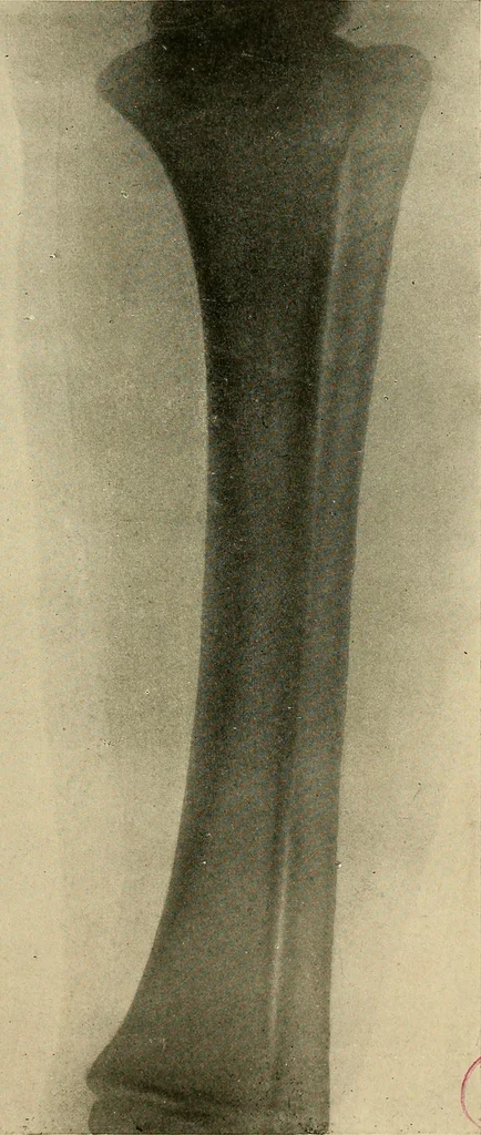 An illustration from The Roentgen rays in medicine and surgery as an aid in diagnosis and as a therapeutic agent : designed for the use of practitioners and students, 1901, leaf 530