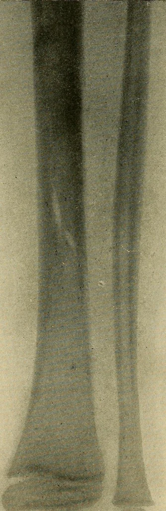 An illustration from The Roentgen rays in medicine and surgery as an aid in diagnosis and as a therapeutic agent : designed for the use of practitioners and students, 1901, leaf 531