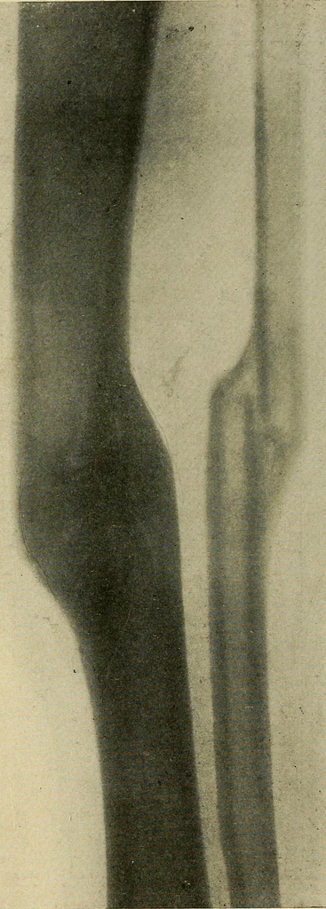 An illustration from The Roentgen rays in medicine and surgery as an aid in diagnosis and as a therapeutic agent : designed for the use of practitioners and students, 1901, leaf 533