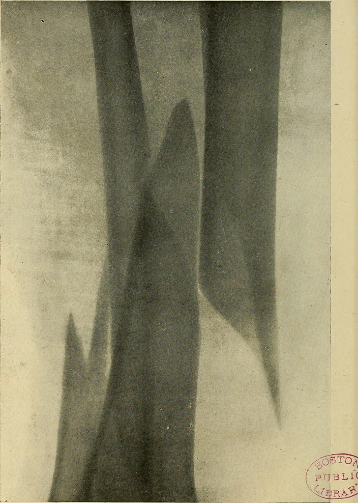 An illustration from The Roentgen rays in medicine and surgery as an aid in diagnosis and as a therapeutic agent : designed for the use of practitioners and students, 1901, leaf 535