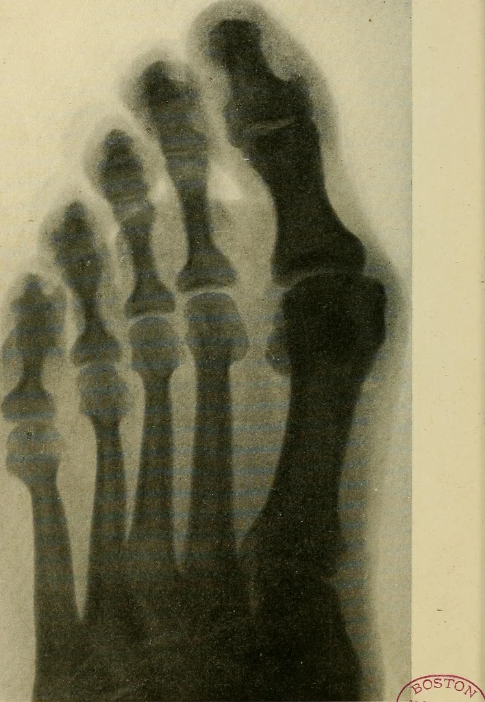 An illustration from The Roentgen rays in medicine and surgery as an aid in diagnosis and as a therapeutic agent : designed for the use of practitioners and students, 1901, leaf 541