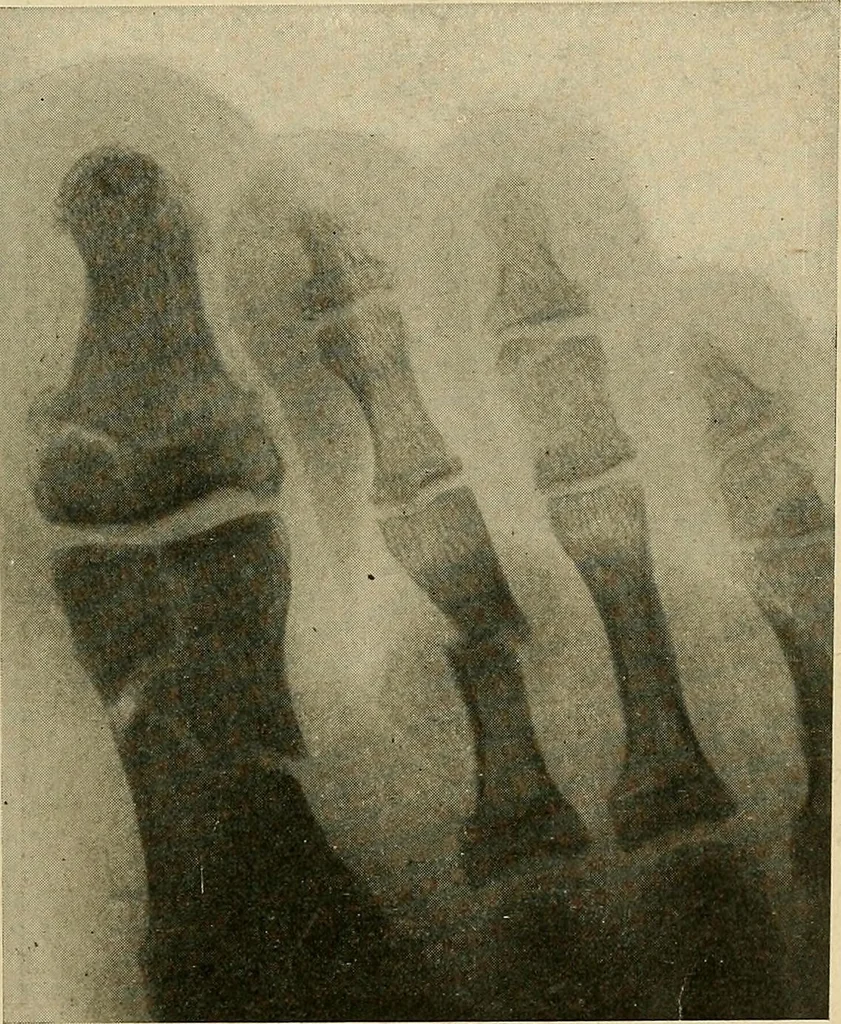 An illustration from The Roentgen rays in medicine and surgery as an aid in diagnosis and as a therapeutic agent : designed for the use of practitioners and students, 1901, leaf 542