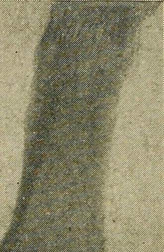 An illustration from The Roentgen rays in medicine and surgery as an aid in diagnosis and as a therapeutic agent : designed for the use of practitioners and students, 1901, leaf 543