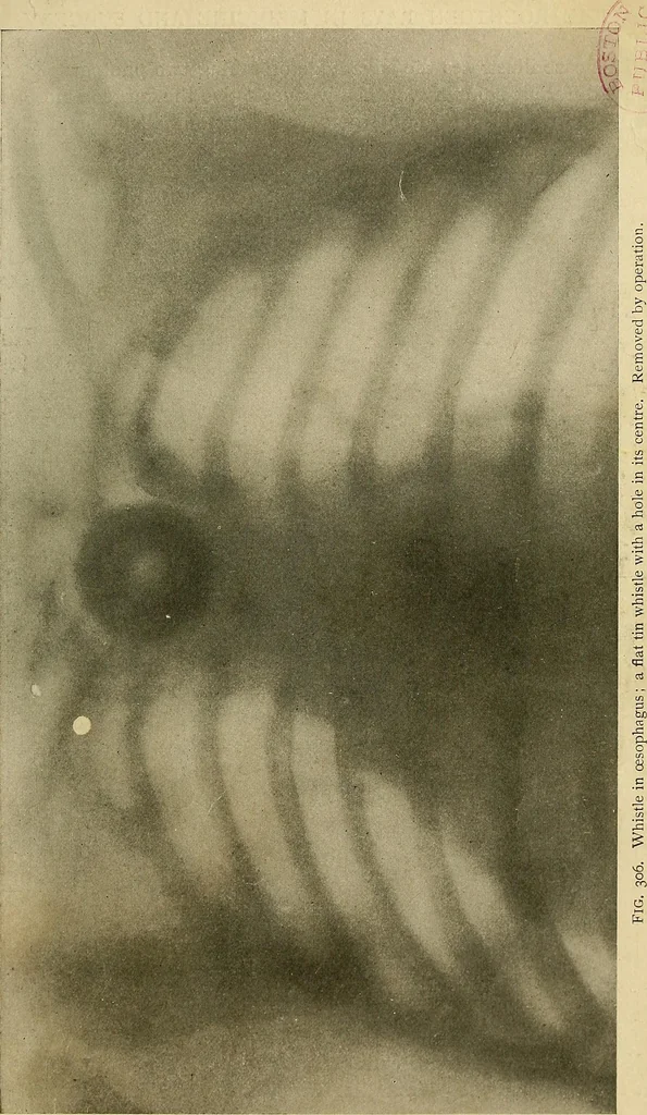 An illustration from The Roentgen rays in medicine and surgery as an aid in diagnosis and as a therapeutic agent : designed for the use of practitioners and students, 1901, leaf 558