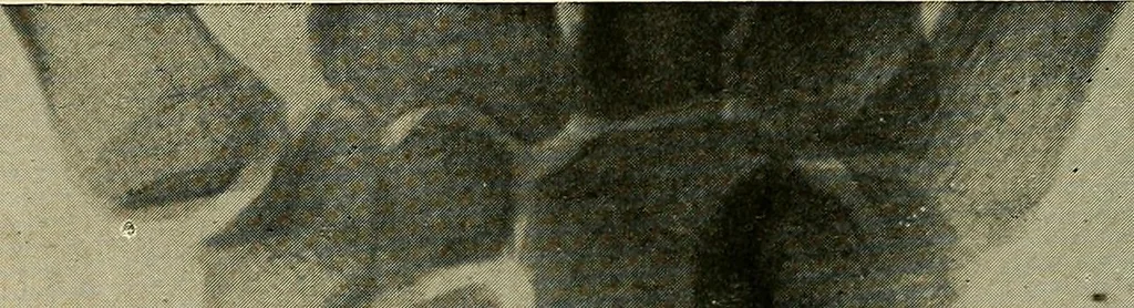 An illustration from The Roentgen rays in medicine and surgery as an aid in diagnosis and as a therapeutic agent : designed for the use of practitioners and students, 1901, leaf 559