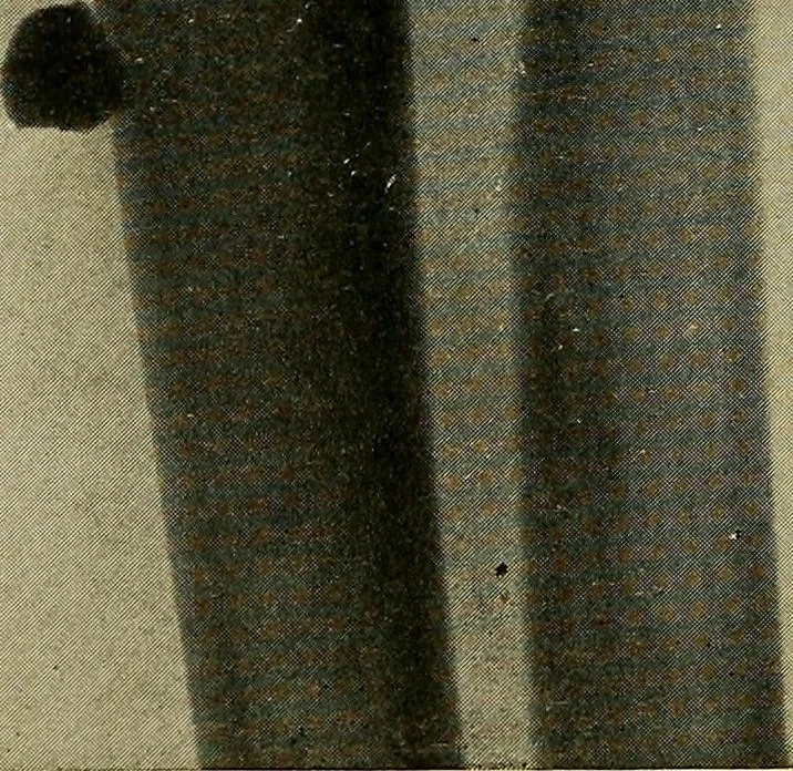An illustration from The Roentgen rays in medicine and surgery as an aid in diagnosis and as a therapeutic agent : designed for the use of practitioners and students, 1901, leaf 559