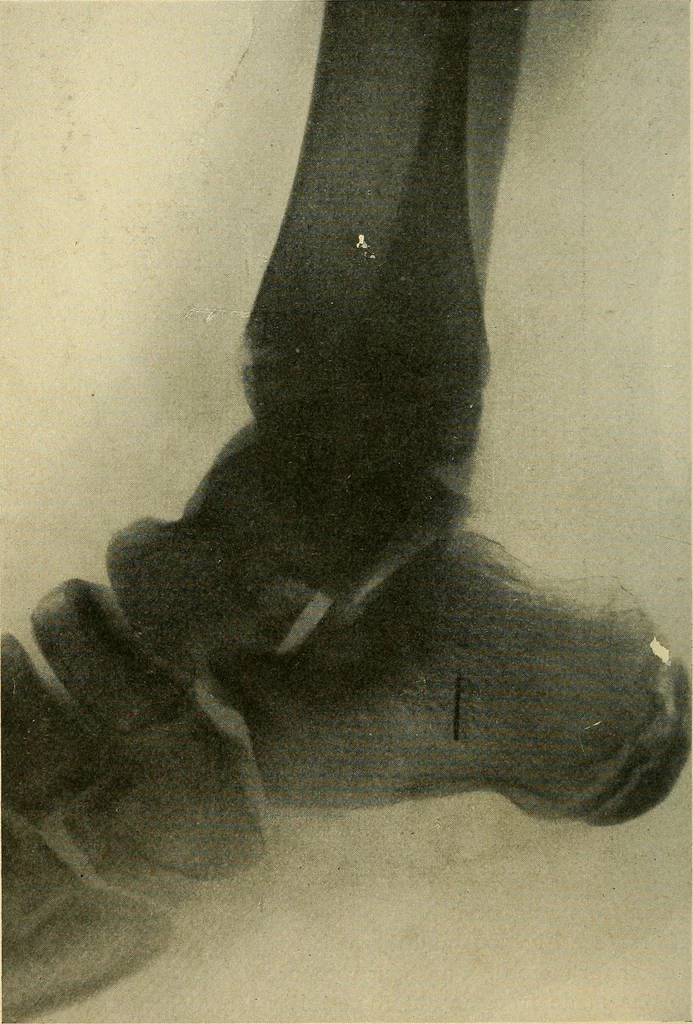 An illustration from The Roentgen rays in medicine and surgery as an aid in diagnosis and as a therapeutic agent : designed for the use of practitioners and students, 1901, leaf 561