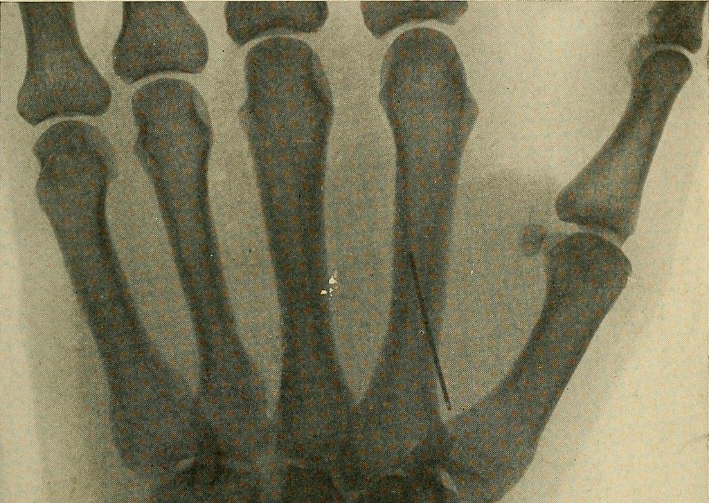 An illustration from The Roentgen rays in medicine and surgery as an aid in diagnosis and as a therapeutic agent : designed for the use of practitioners and students, 1901, leaf 562