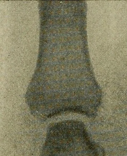 An illustration from The Roentgen rays in medicine and surgery as an aid in diagnosis and as a therapeutic agent : designed for the use of practitioners and students, 1901, leaf 563
