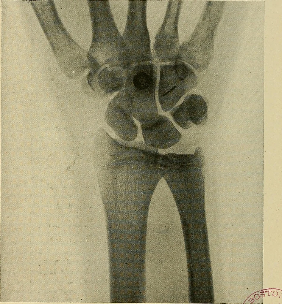An illustration from The Roentgen rays in medicine and surgery as an aid in diagnosis and as a therapeutic agent : designed for the use of practitioners and students, 1901, leaf 565