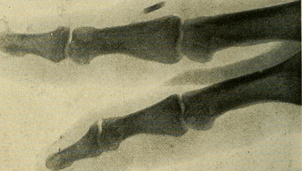 An illustration from The Roentgen rays in medicine and surgery as an aid in diagnosis and as a therapeutic agent : designed for the use of practitioners and students, 1901, leaf 567
