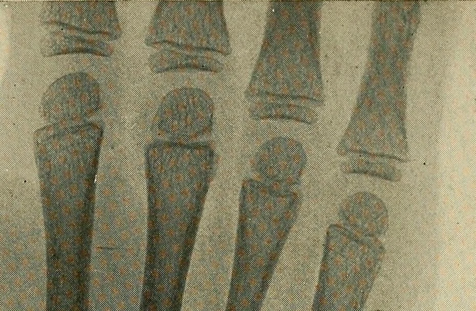 An illustration from The Roentgen rays in medicine and surgery as an aid in diagnosis and as a therapeutic agent : designed for the use of practitioners and students, 1901, leaf 574
