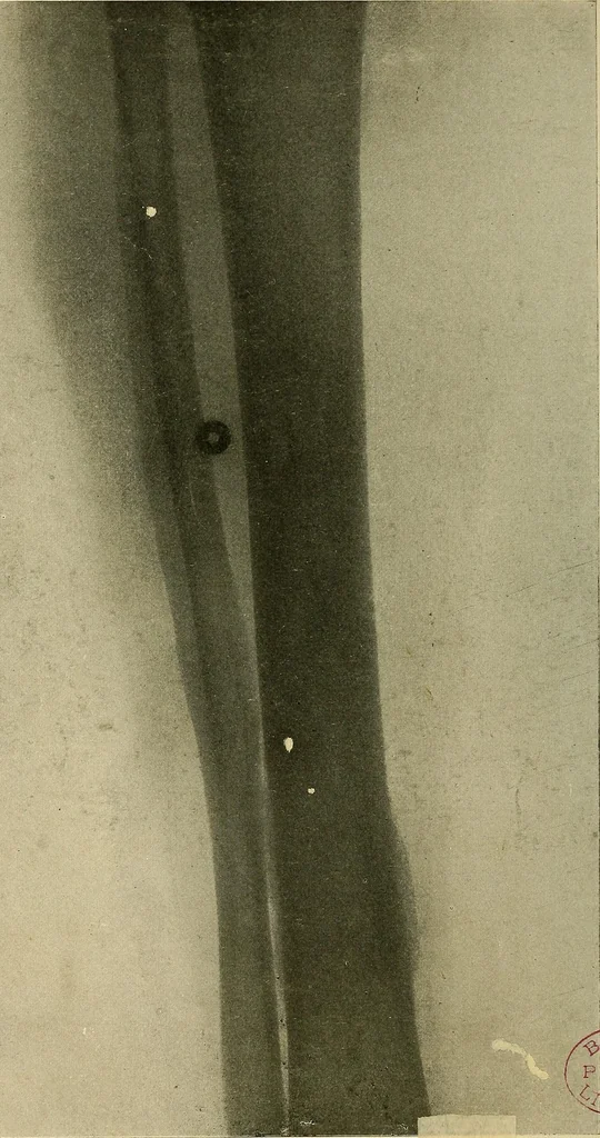 An illustration from The Roentgen rays in medicine and surgery as an aid in diagnosis and as a therapeutic agent : designed for the use of practitioners and students, 1901, leaf 575