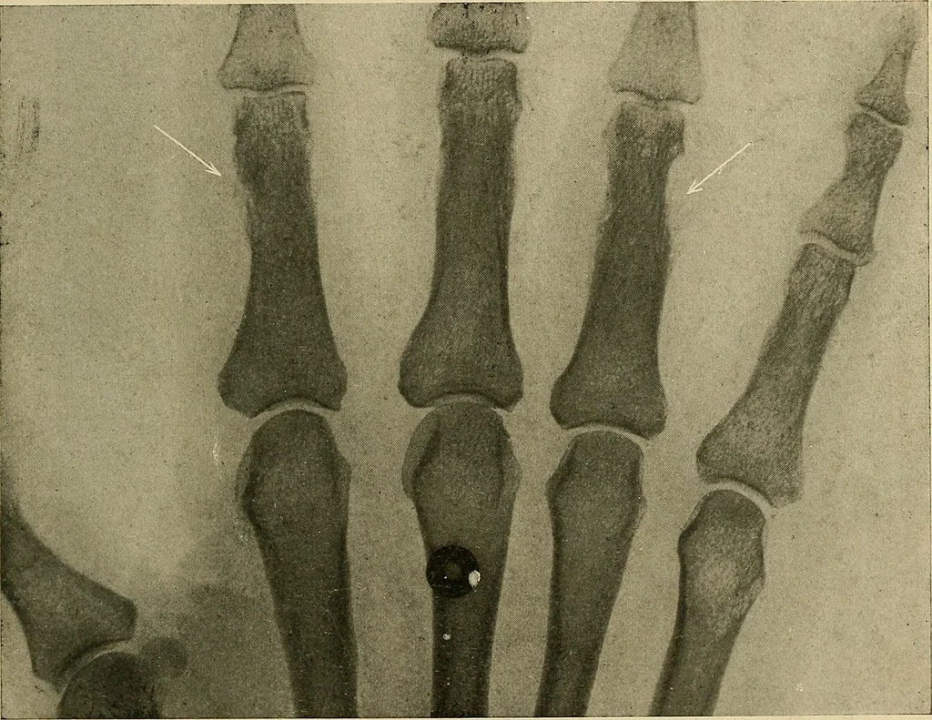 An illustration from The Roentgen rays in medicine and surgery as an aid in diagnosis and as a therapeutic agent : designed for the use of practitioners and students, 1901, leaf 576