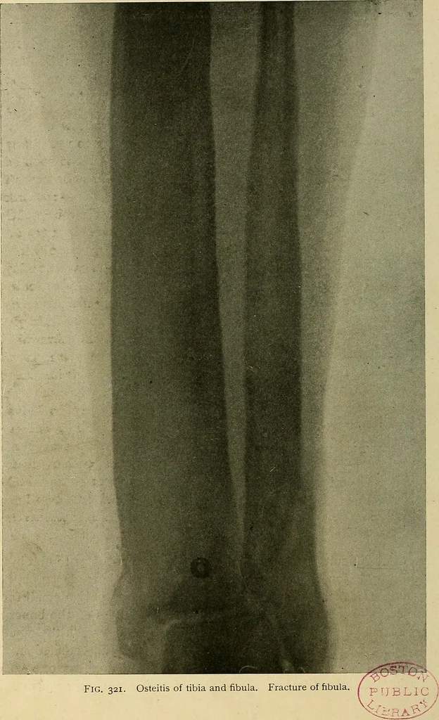 An illustration from The Roentgen rays in medicine and surgery as an aid in diagnosis and as a therapeutic agent : designed for the use of practitioners and students, 1901, leaf 577