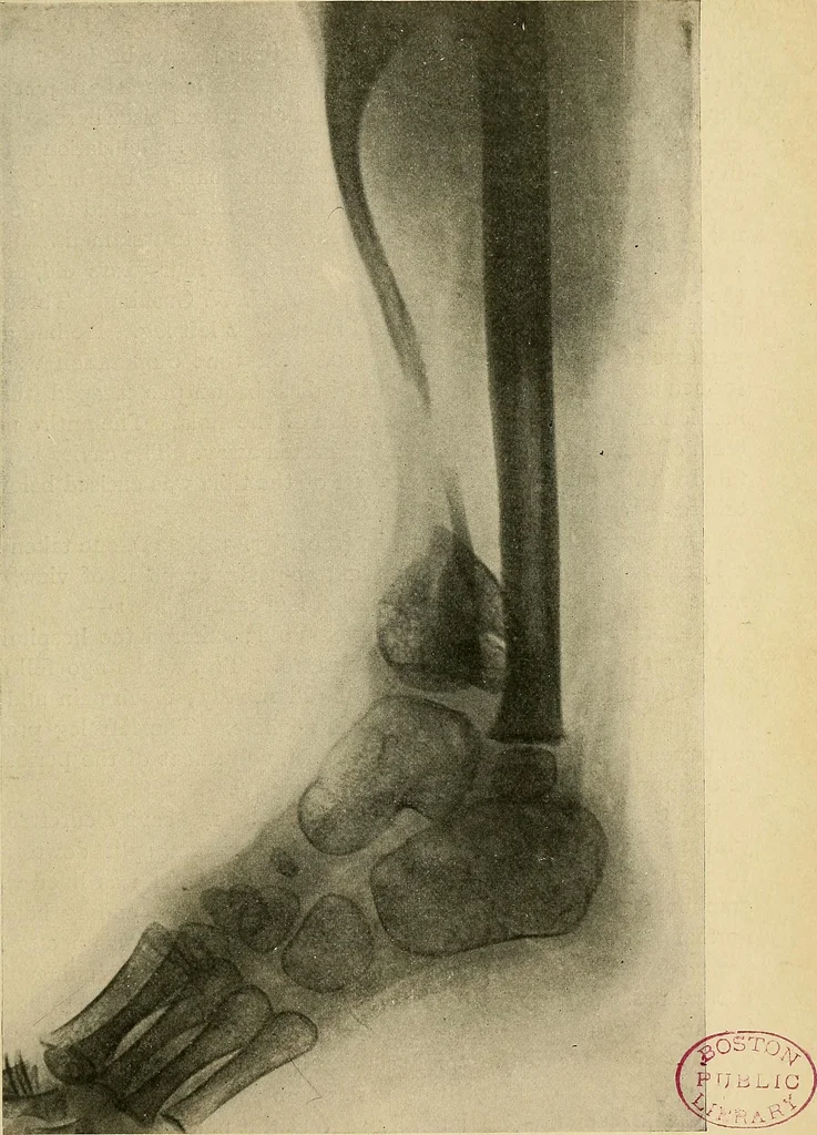 An illustration from The Roentgen rays in medicine and surgery as an aid in diagnosis and as a therapeutic agent : designed for the use of practitioners and students, 1901, leaf 580