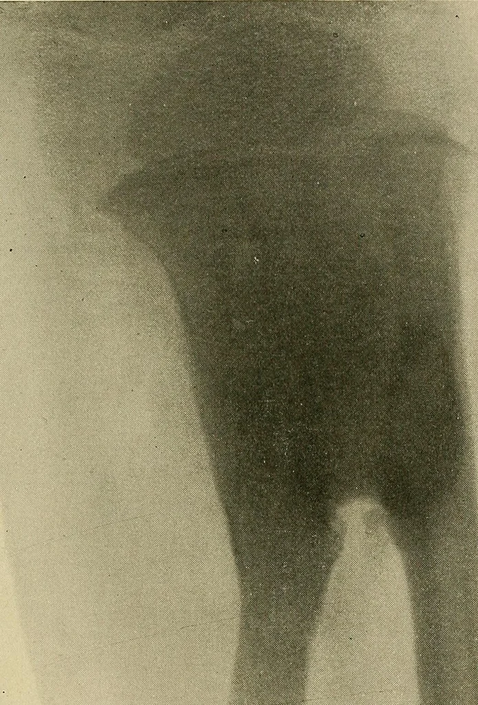 An illustration from The Roentgen rays in medicine and surgery as an aid in diagnosis and as a therapeutic agent : designed for the use of practitioners and students, 1901, leaf 582