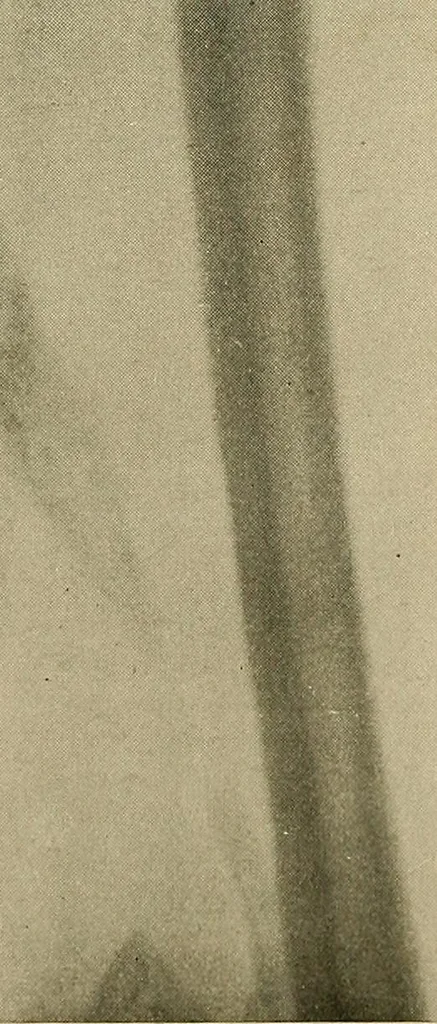 An illustration from The Roentgen rays in medicine and surgery as an aid in diagnosis and as a therapeutic agent : designed for the use of practitioners and students, 1901, leaf 582