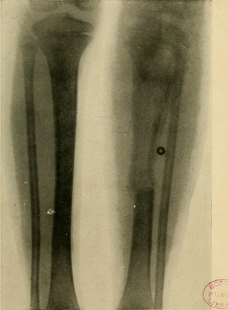 An illustration from The Roentgen rays in medicine and surgery as an aid in diagnosis and as a therapeutic agent : designed for the use of practitioners and students, 1901, leaf 584