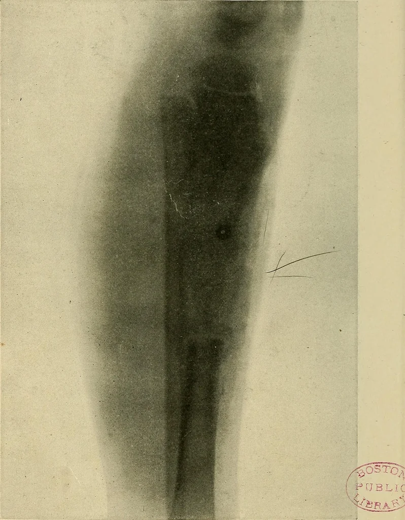 An illustration from The Roentgen rays in medicine and surgery as an aid in diagnosis and as a therapeutic agent : designed for the use of practitioners and students, 1901, leaf 585
