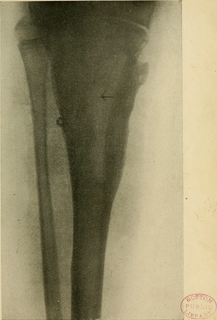 An illustration from The Roentgen rays in medicine and surgery as an aid in diagnosis and as a therapeutic agent : designed for the use of practitioners and students, 1901, leaf 586