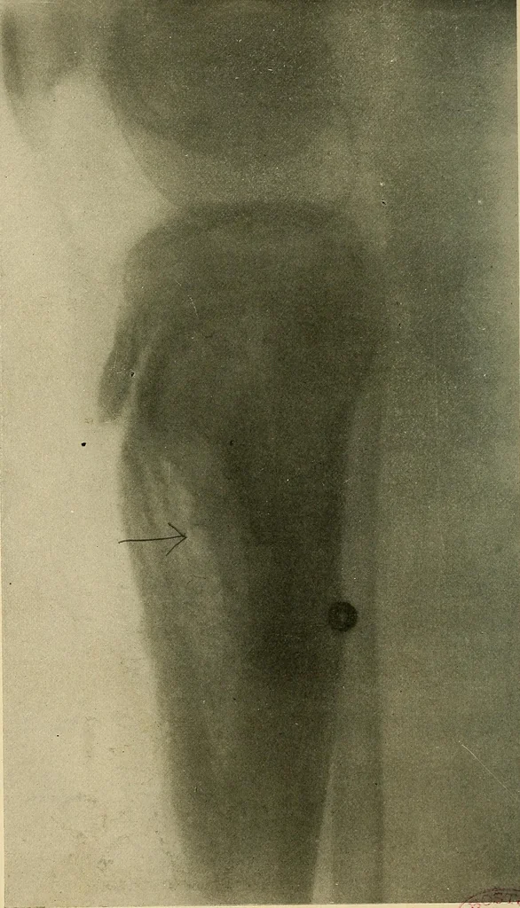 An illustration from The Roentgen rays in medicine and surgery as an aid in diagnosis and as a therapeutic agent : designed for the use of practitioners and students, 1901, leaf 587
