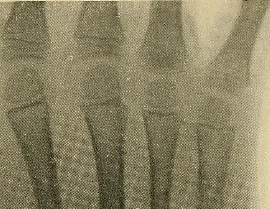 An illustration from The Roentgen rays in medicine and surgery as an aid in diagnosis and as a therapeutic agent : designed for the use of practitioners and students, 1901, leaf 588