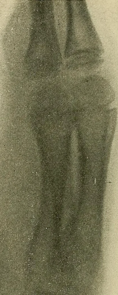 An illustration from The Roentgen rays in medicine and surgery as an aid in diagnosis and as a therapeutic agent : designed for the use of practitioners and students, 1901, leaf 589