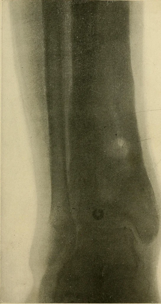 An illustration from The Roentgen rays in medicine and surgery as an aid in diagnosis and as a therapeutic agent : designed for the use of practitioners and students, 1901, leaf 590